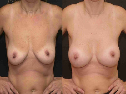 Breast Augmentation Surgery