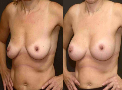 Breast Augmentation Surgery