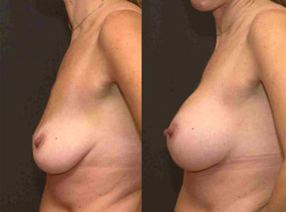 Breast Augmentation Surgery