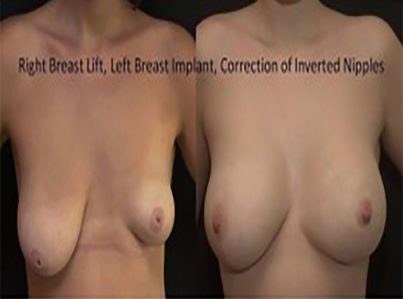 Breast Augmentation Surgery