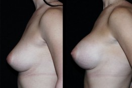 Breast Augmentation Surgery