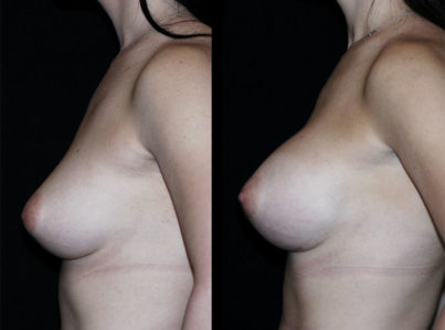 Breast Augmentation Surgery