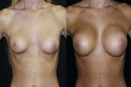 Breast Augmentation Surgery