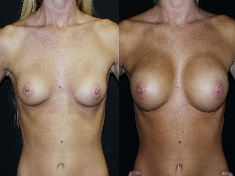 Breast Augmentation Surgery