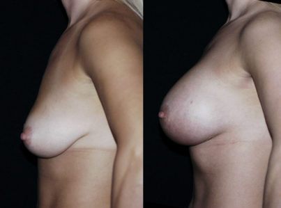 Breast Augmentation Surgery