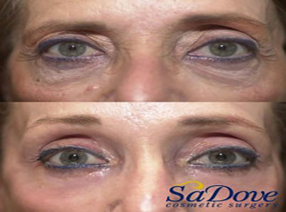 Upper Eyelid Surgery