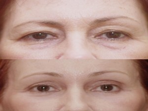 Upper Eyelid Surgery