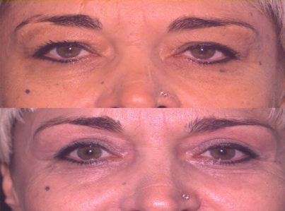 Upper Eyelid Surgery