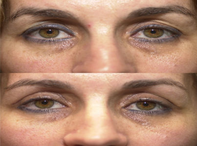 Upper Eyelid Surgery