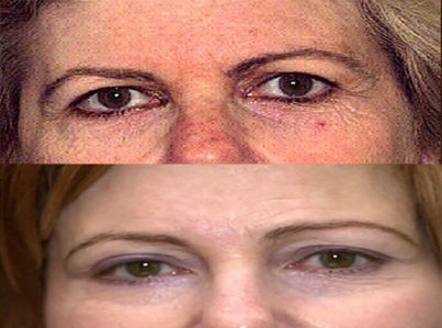 Upper Eyelid Surgery