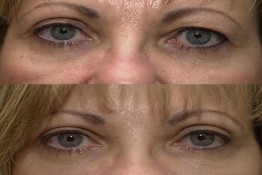 Upper Eyelid Surgery