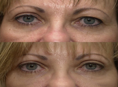 Upper Eyelid Surgery