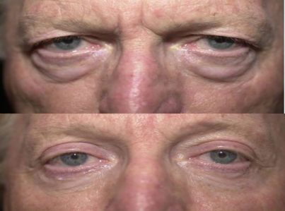 Upper Eyelid Surgery