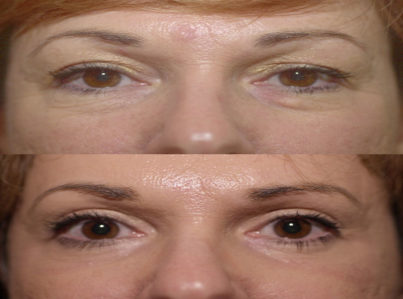 Upper Eyelid Surgery