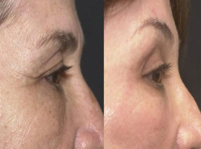 Upper Eyelid Surgery