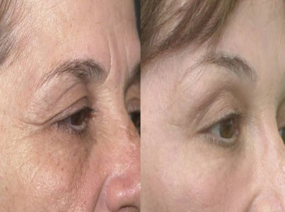 Upper Eyelid Surgery