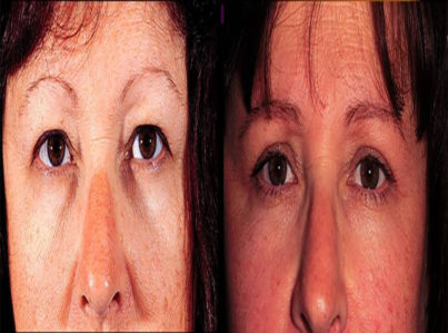 Upper Eyelid Surgery