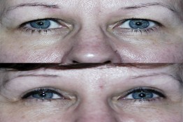 Upper Eyelid Surgery