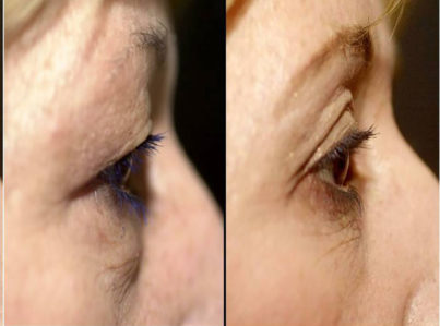 Upper Eyelid Surgery