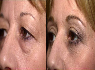 Upper Eyelid Surgery