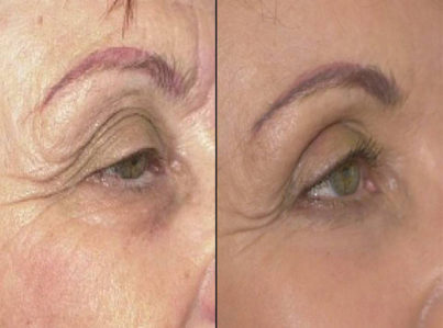 Upper Eyelid Surgery