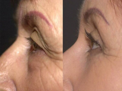 Upper Eyelid Surgery