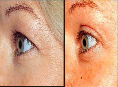 Upper Eyelid Surgery