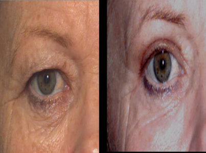 Upper Eyelid Surgery