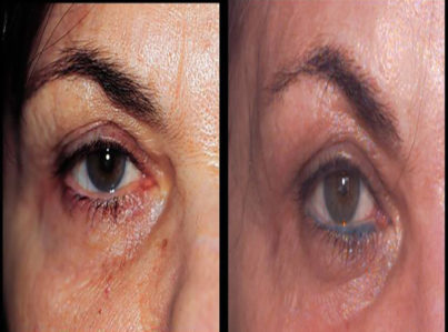 Upper Eyelid Surgery