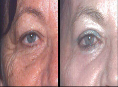 Upper Eyelid Surgery