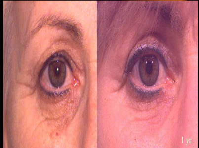 Upper Eyelid Surgery