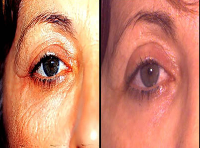 Upper Eyelid Surgery