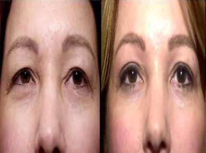 Upper Eyelid Surgery