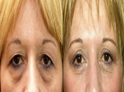 Upper Eyelid Surgery