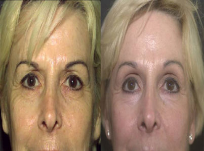 Upper Eyelid Surgery