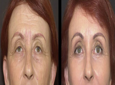 Upper Eyelid Surgery