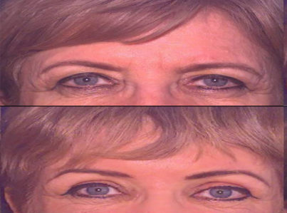 Upper Eyelid Surgery