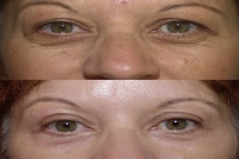 Upper Eyelid Surgery