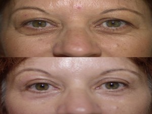 Upper Eyelid Surgery