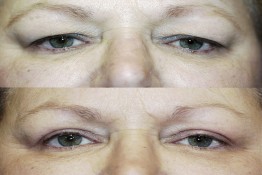 Upper Eyelid Surgery