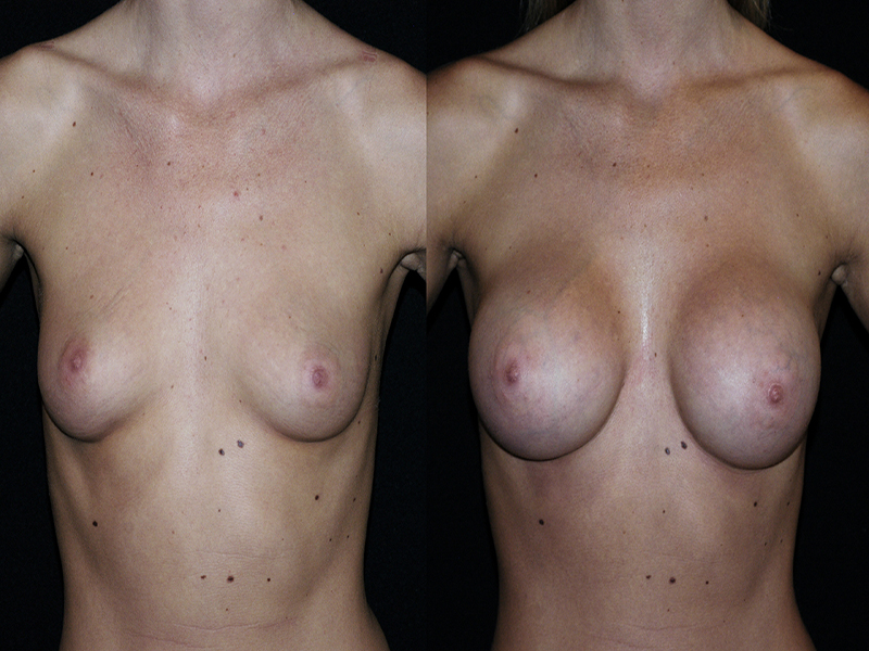 Breast Augmentation Surgery