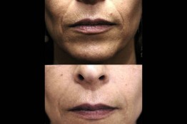 Sculptra Surgery