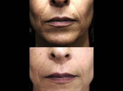 Sculptra Surgery