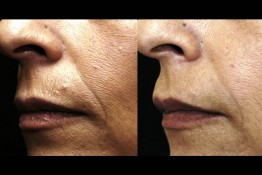 Sculptra Surgery