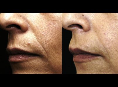 Sculptra Surgery