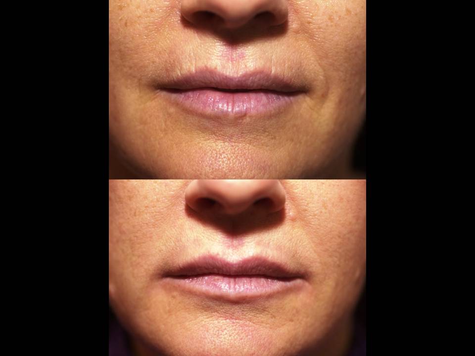 Sculptra Surgery