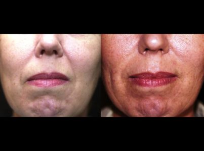 Sculptra Surgery