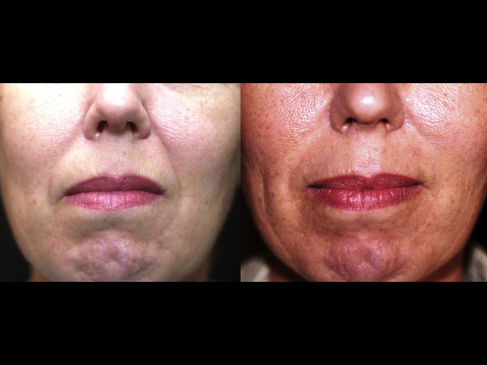 Sculptra Surgery