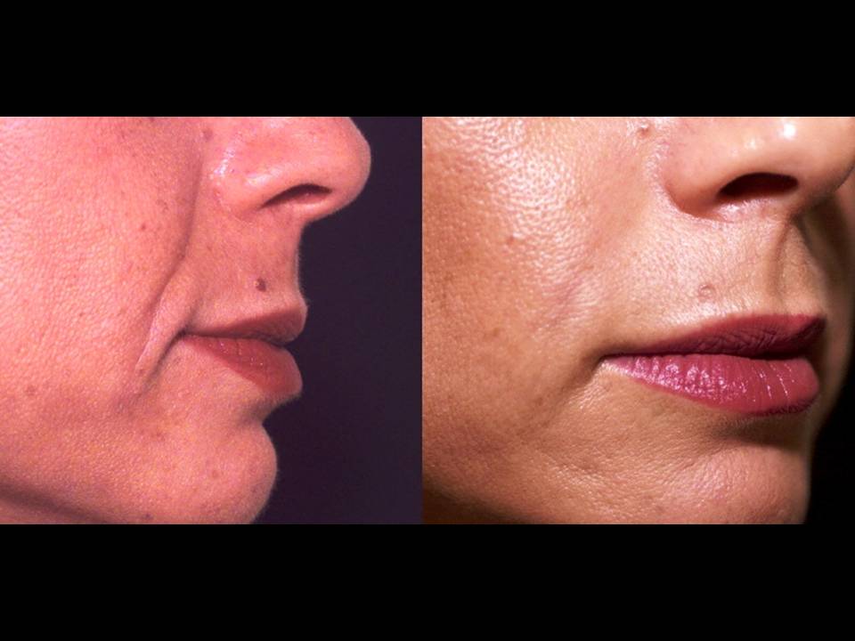 Sculptra Surgery