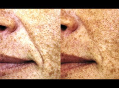 Sculptra Surgery